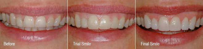 Before/Trial/Final Smile